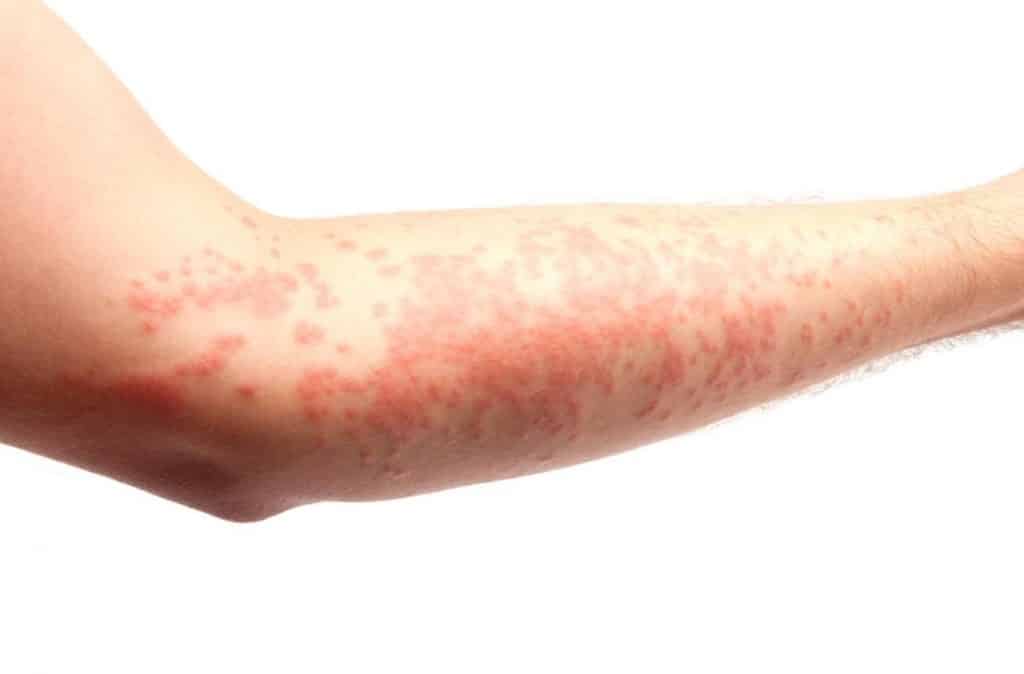 moderate urticaria on forearm due to milk protein intolerance
